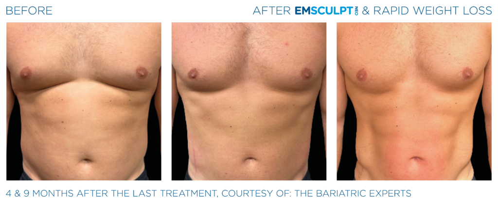 Emsculpt_Neo-Weight-Loss_PIC_Ba-card-male-abdomen-009_ENUS100